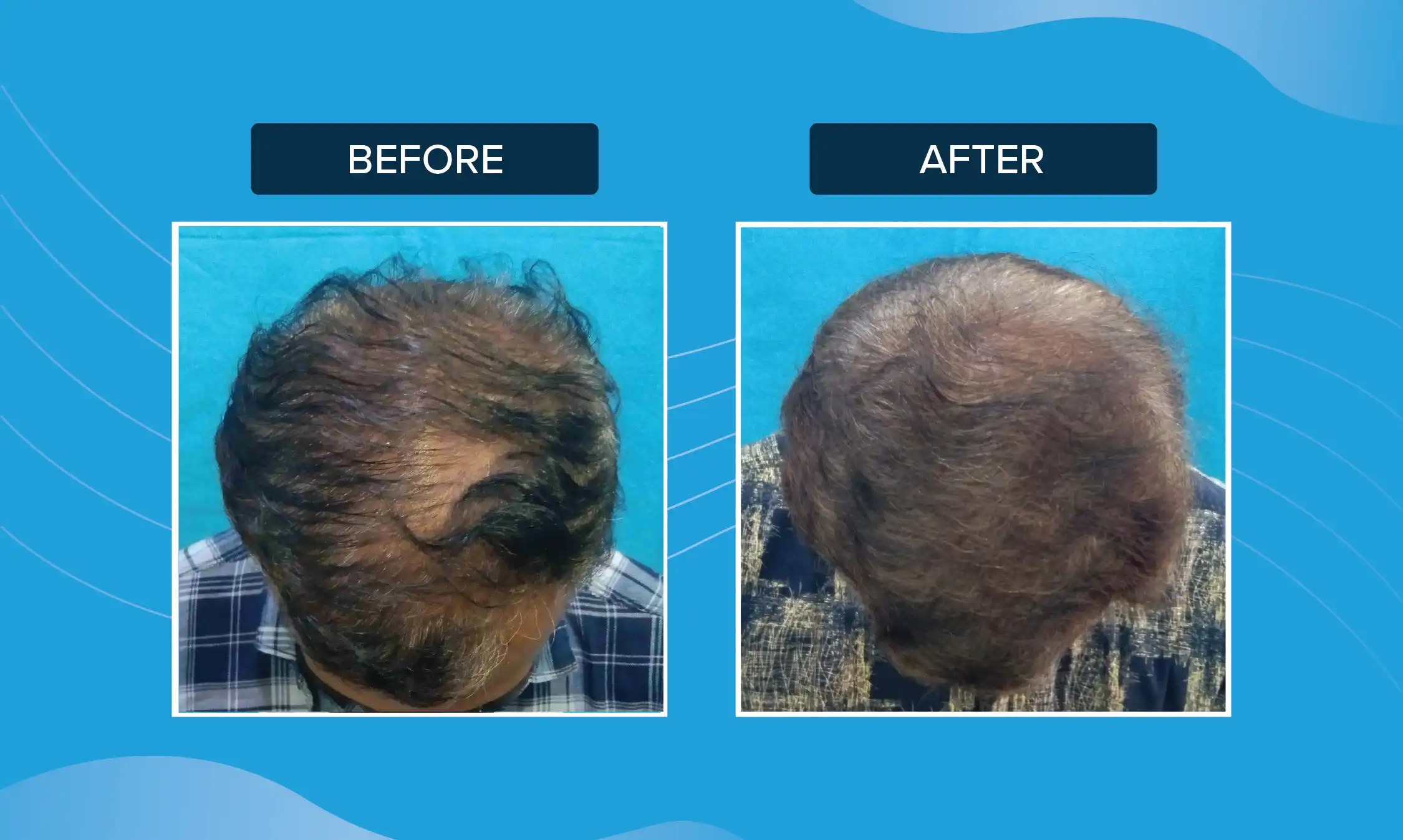 prp for hair growth